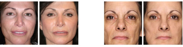 Gesichtsserum, Hautpflege, Ergebnisse, vorher und nachher