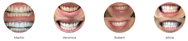 Weißere Zähne, Aufhellungsstreifen, Zähne, Lächeln