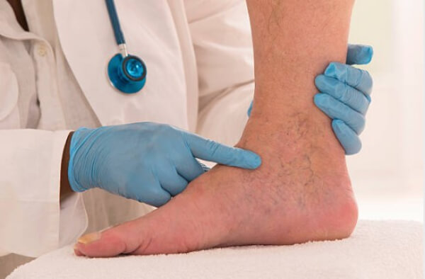 What is done for varicose veins?